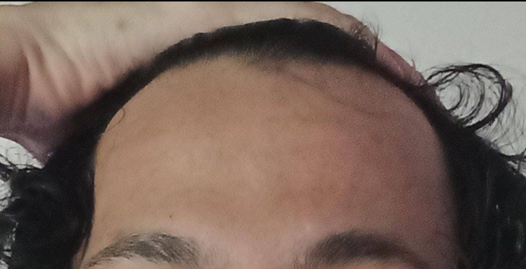 Lord Tetsu DHI hair transplant
